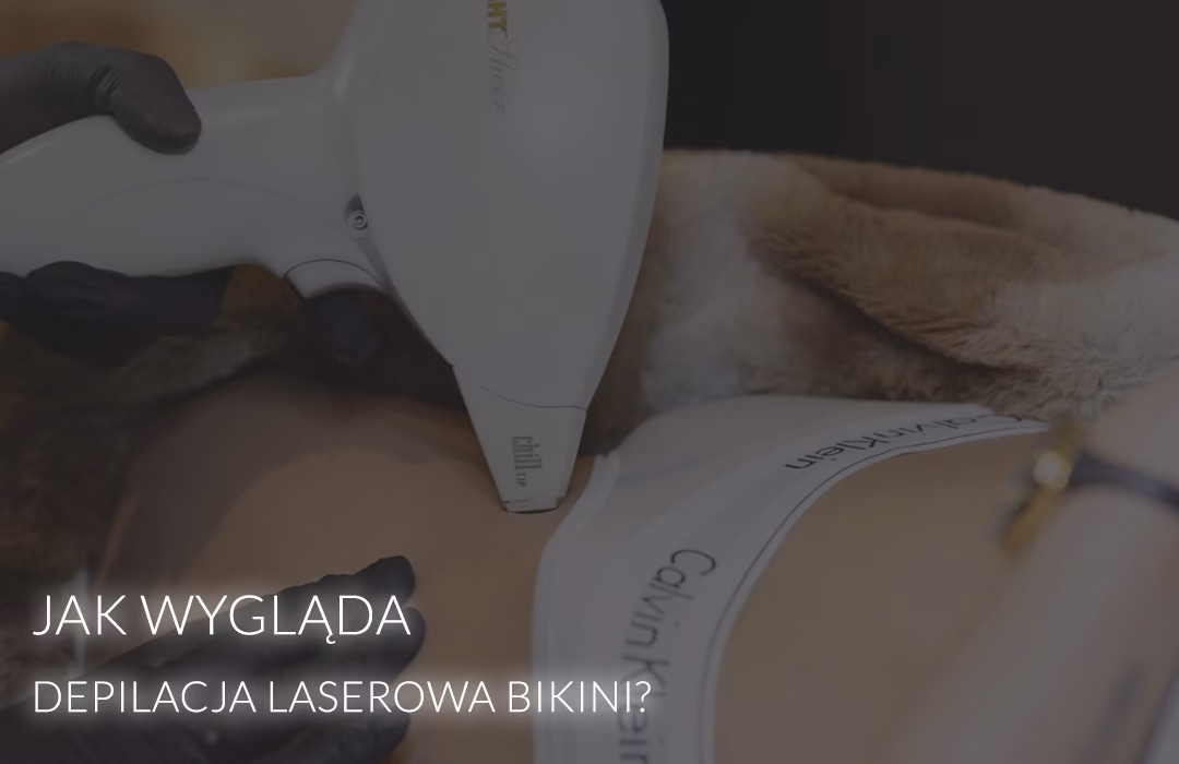 Jakiego typu laserem jest Lumenis Lightsheer?