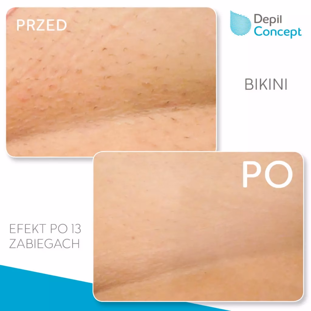 Co jest lepsze depilacja SHR czy laser?