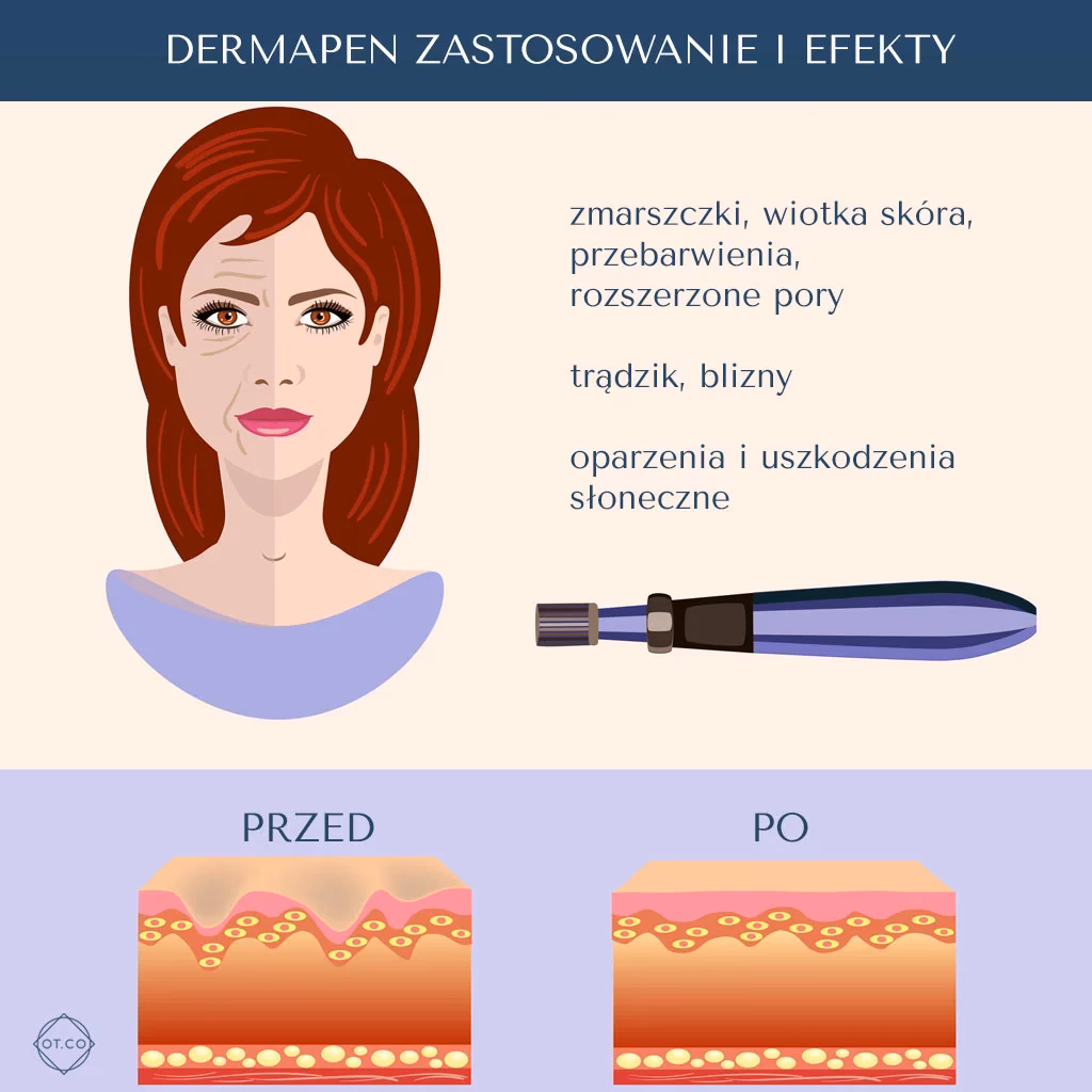 Czy dermapen to medycyna estetyczna?