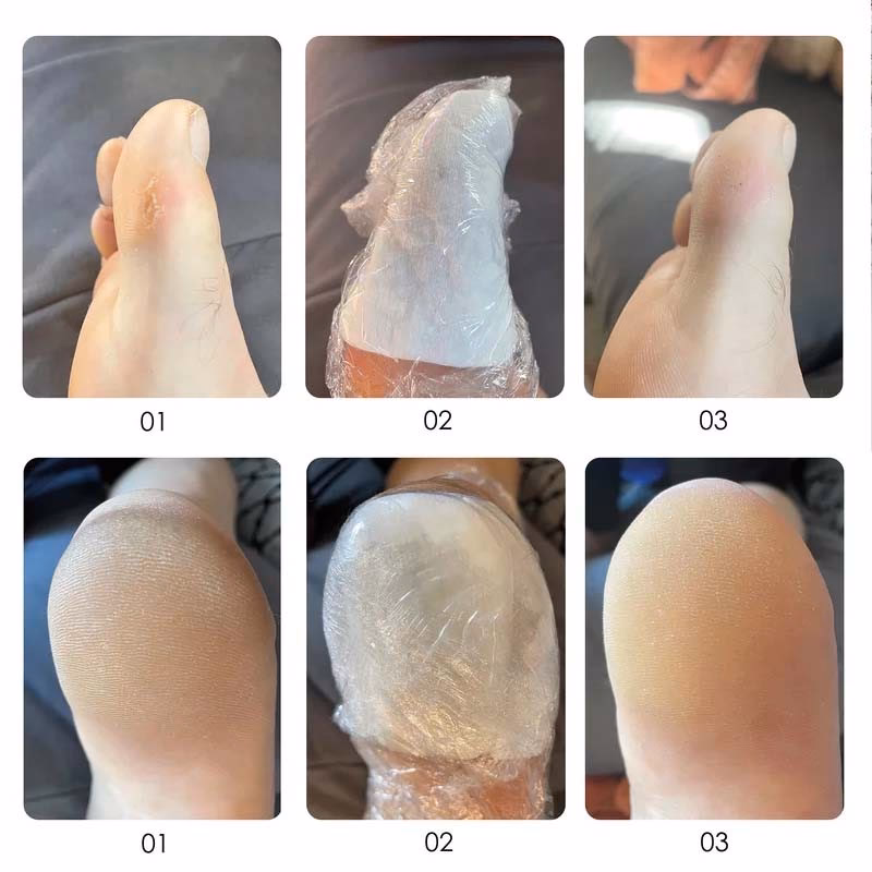 Jak usunąć gruby naskórek ze stóp?