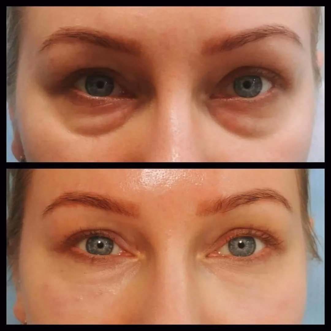 Jaki stymulator tkankowy na dolinę łez?