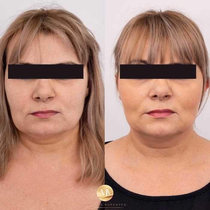 Jak wygląda twarz zaraz po zabiegu HIFU?