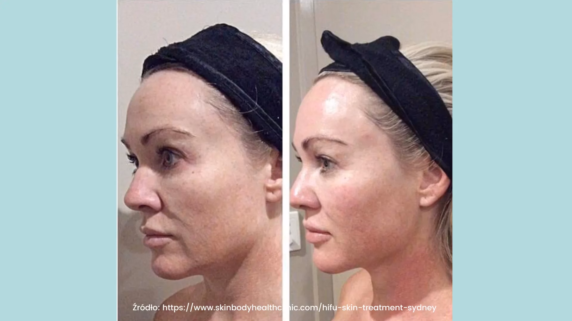 Czy wystarczy jeden zabieg HIFU, aby uzyskać dobry efekt?