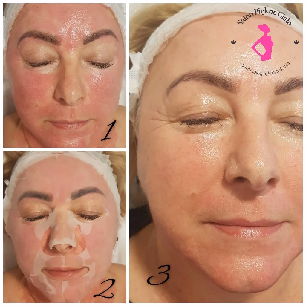 Czy RF usuwa zmarszczki?