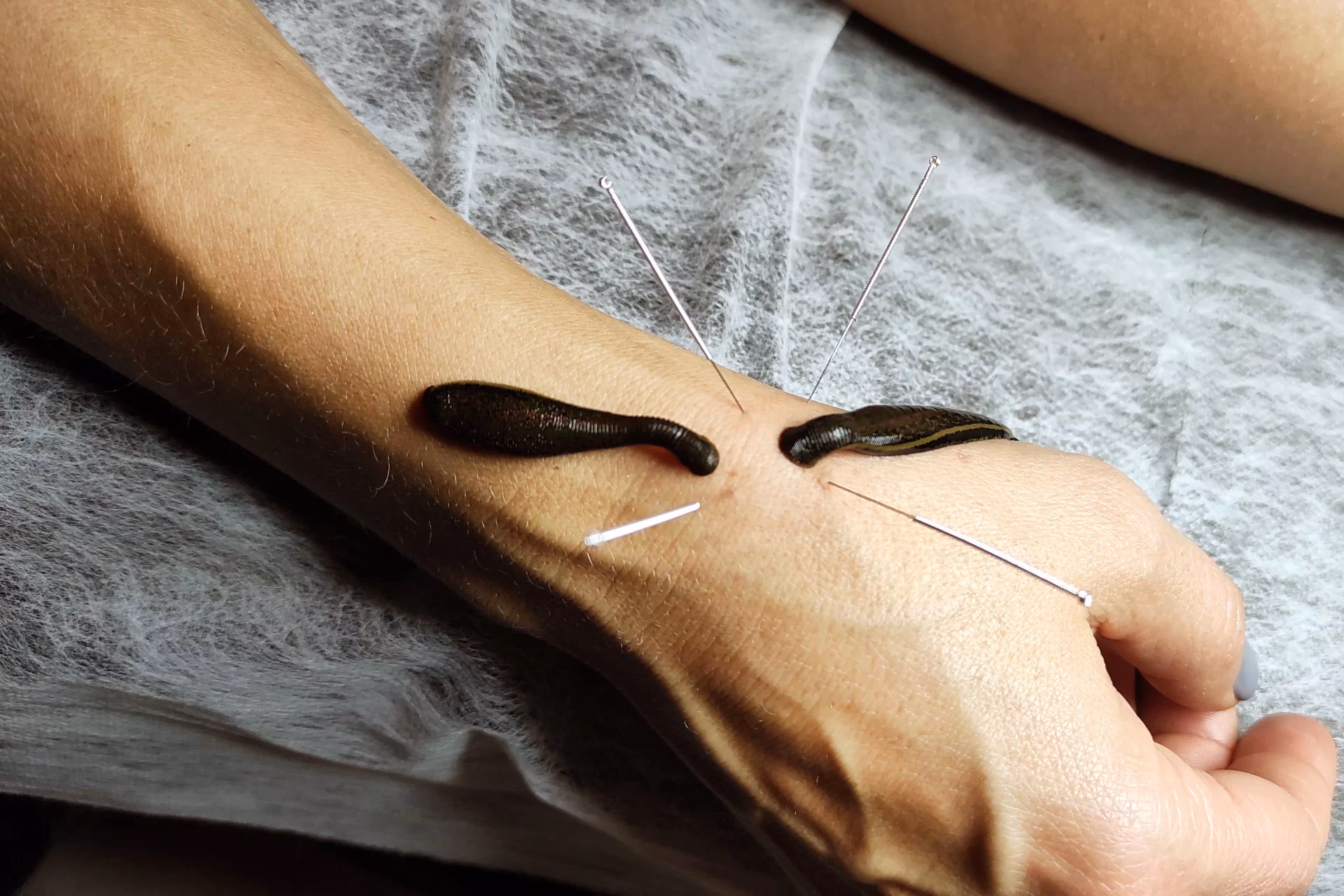 Czy terapia pijawkami jest korzystna dla twarzy?