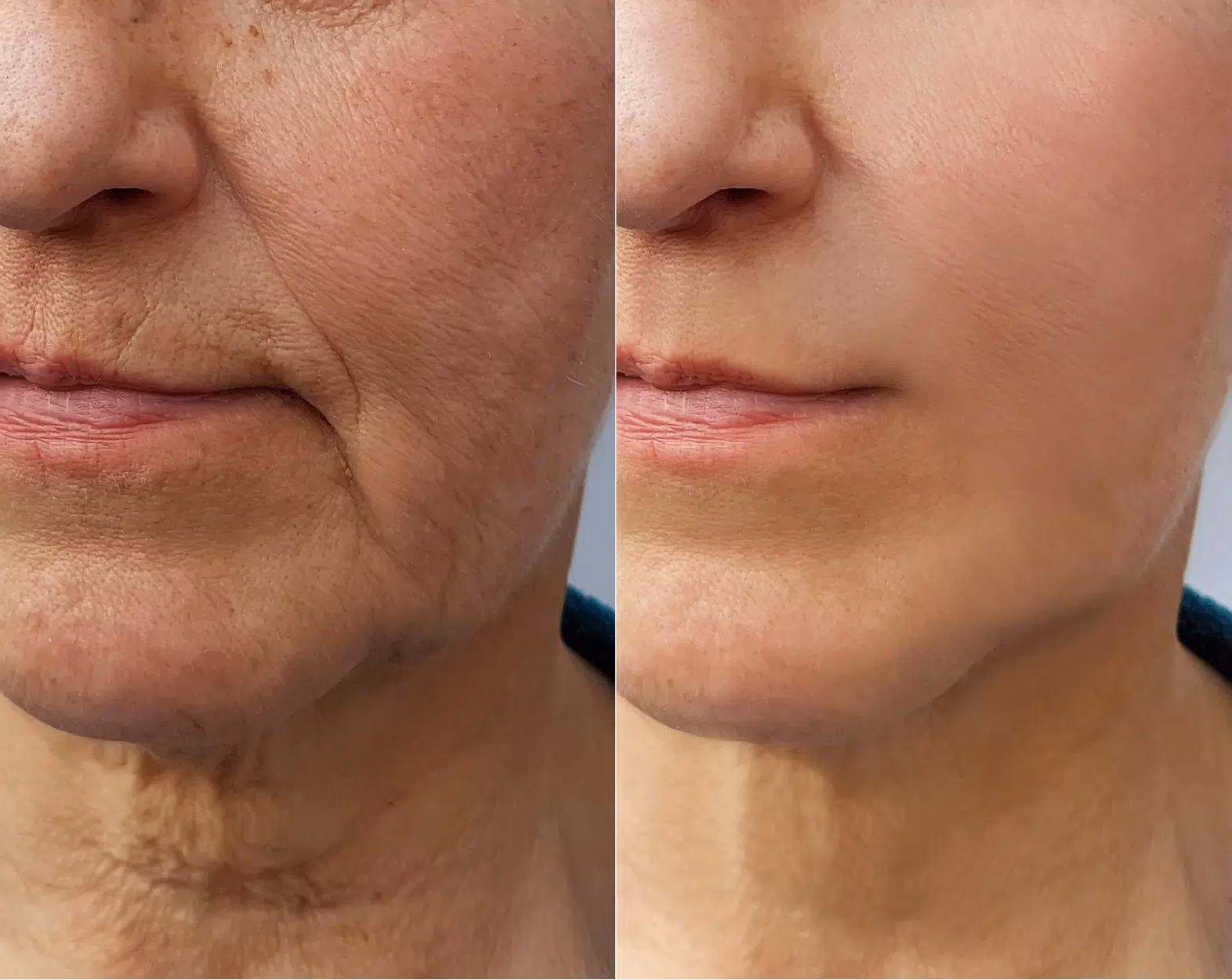 Jaki jest najlepszy zabieg na ujędrnienie twarzy?