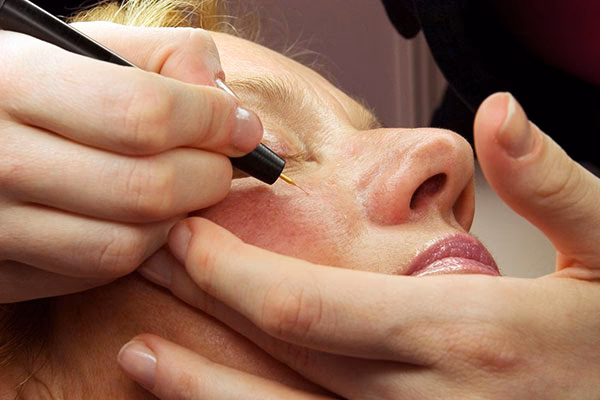 Czy można usunąć punkty rubinowe?