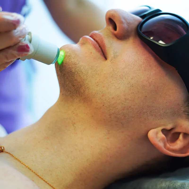 Ile zabiegów laserem na brodę?