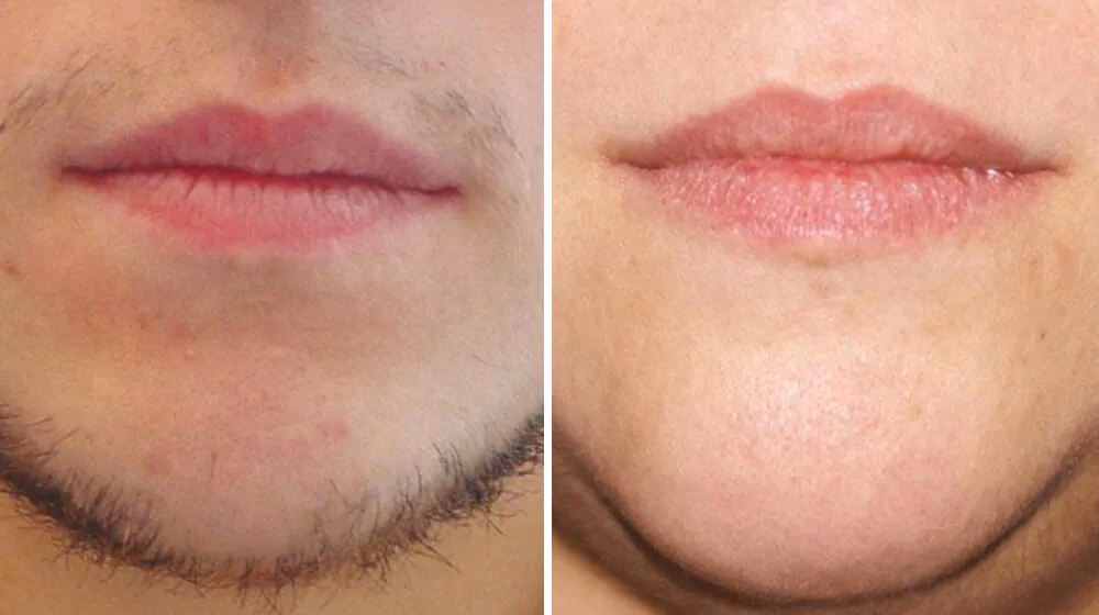 Jak długo utrzymuje się efekt laserowego usuwania brody?