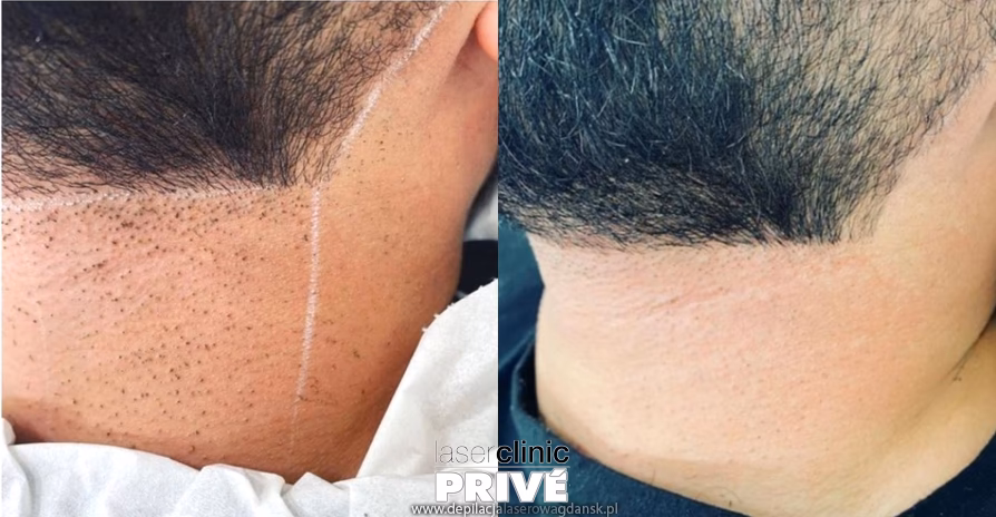Jak długo utrzymuje się efekt laserowego usuwania brody?