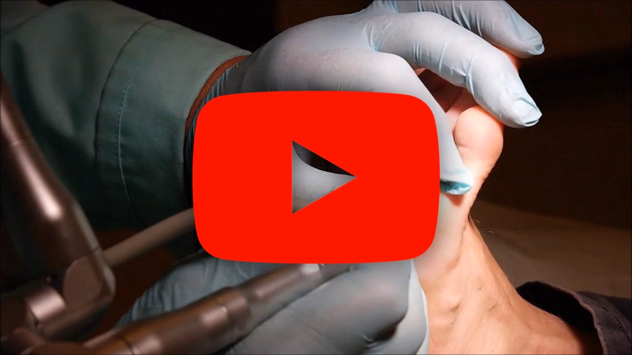 Czy kosmetolodzy mogą usuwać odciski?