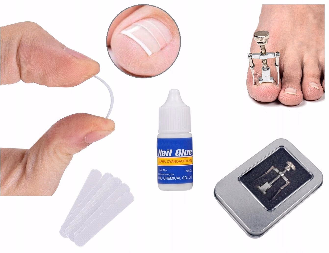 Czy klamry na wrastające paznokcie są skuteczne?