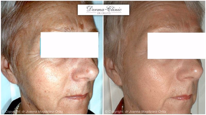 Kiedy nie robić peelingu twarzy?