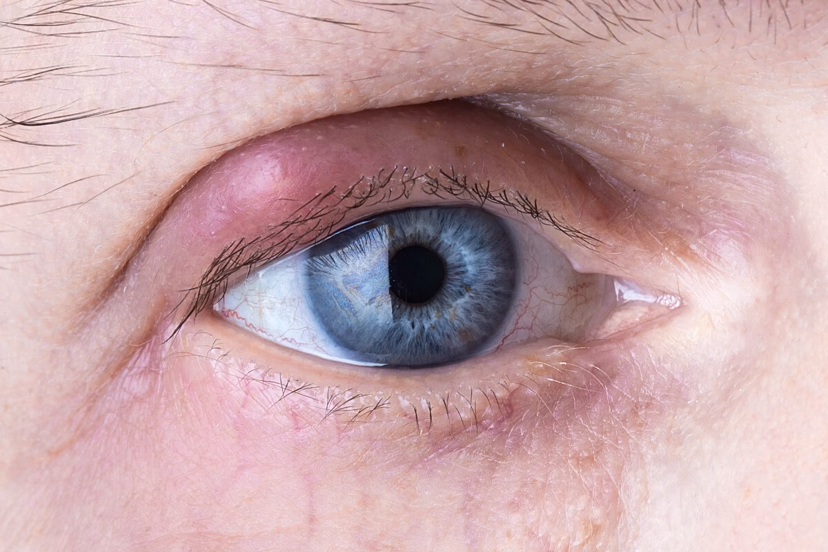 Ile dni trwa gradówka?