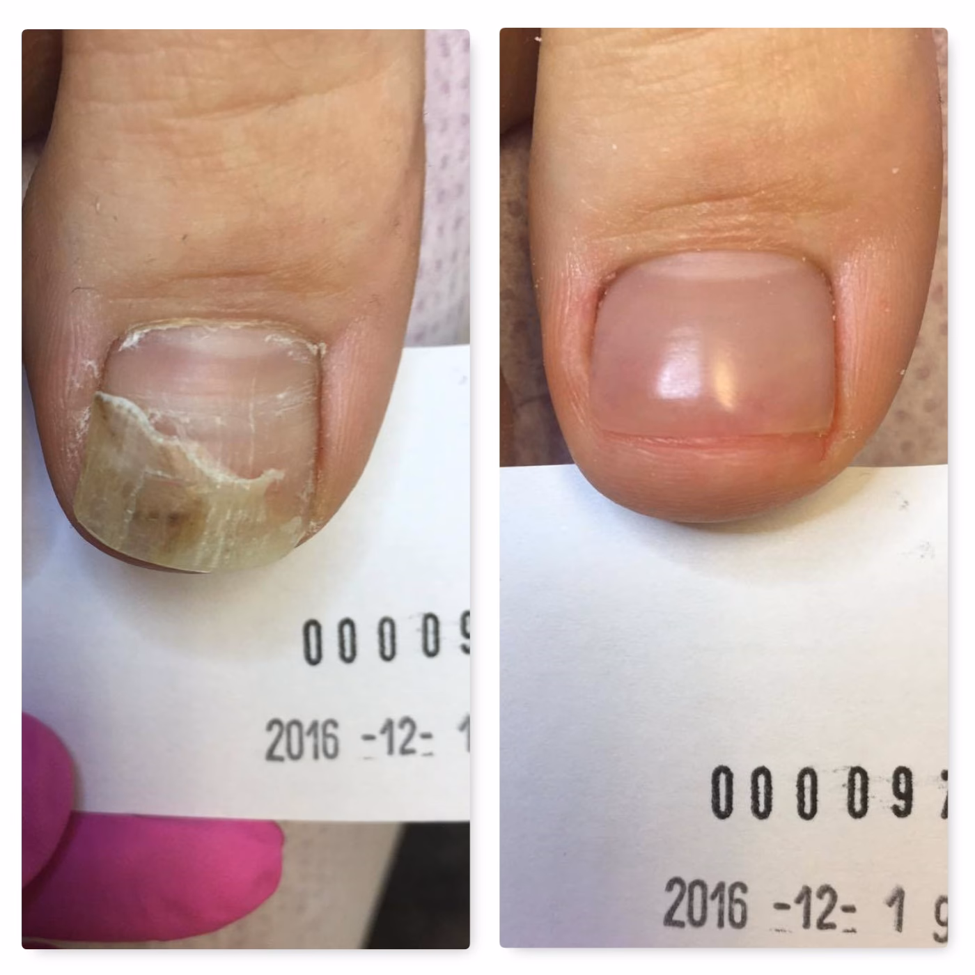 Ile kosztuje pozbycie się grzybicy paznokci?