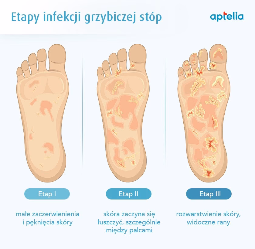 Jak usunąć grzybicę ze stóp?