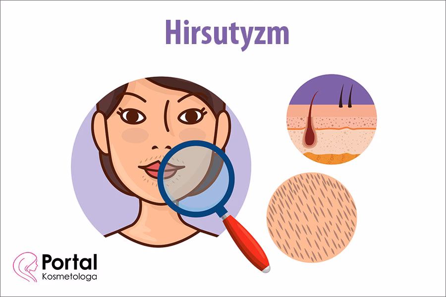 Jak dermatolodzy leczą hirsutyzm?