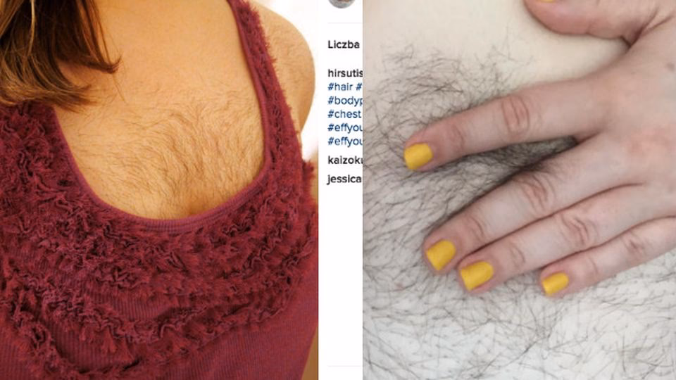 Do jakiego lekarza iść z hirsutyzmem?