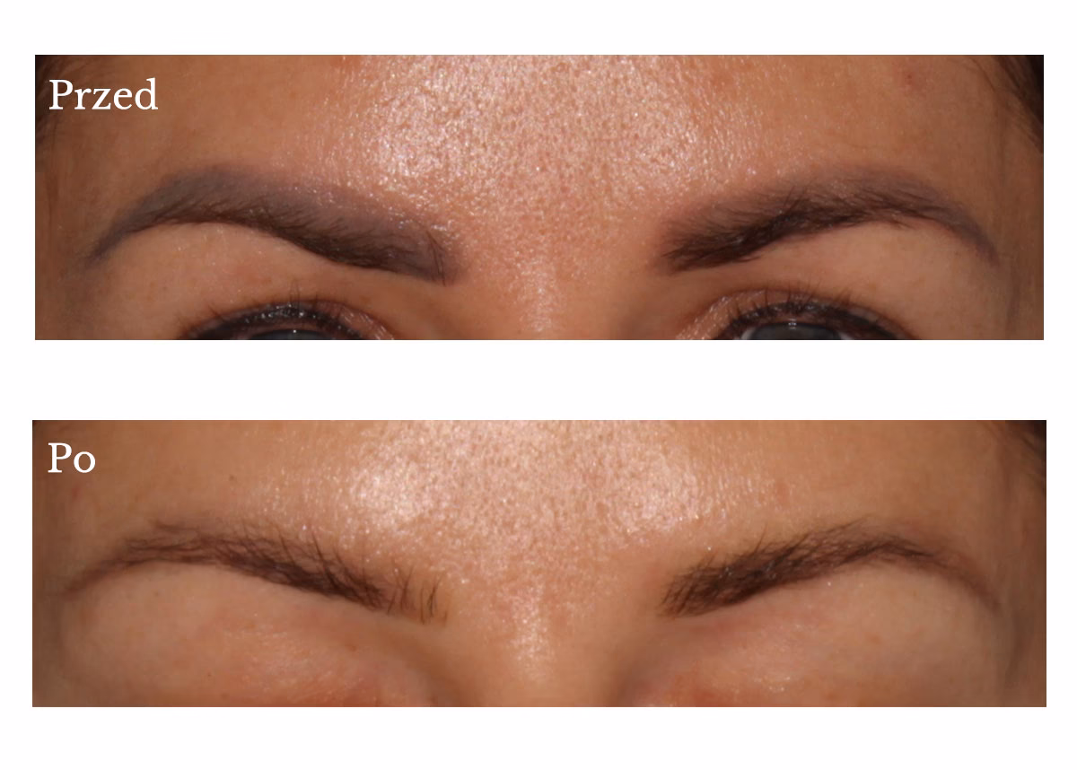 Ile goją się brwi po removerze?