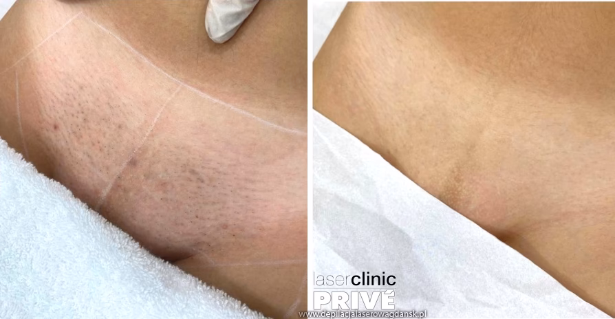 Jak się ubrać na depilację laserową bikini?