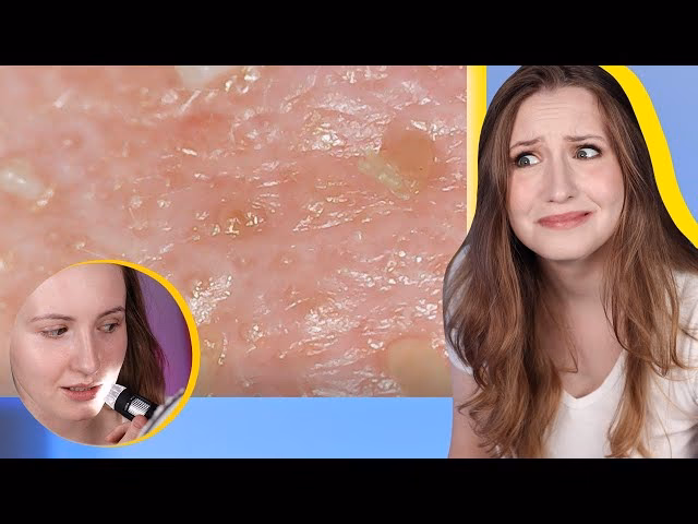 Czym kosmetyczka wyciska pryszcze?