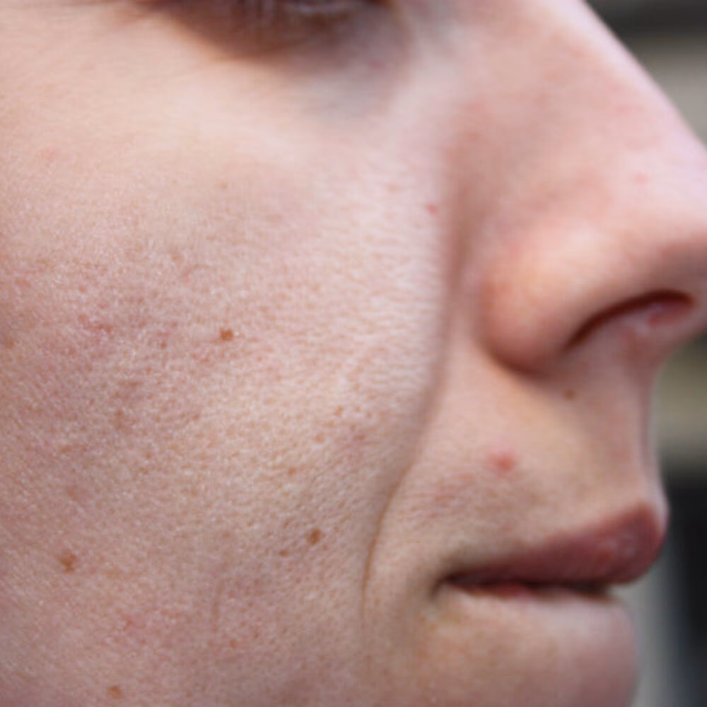 Jak szybko pozbyć się zaskórników zamkniętych?