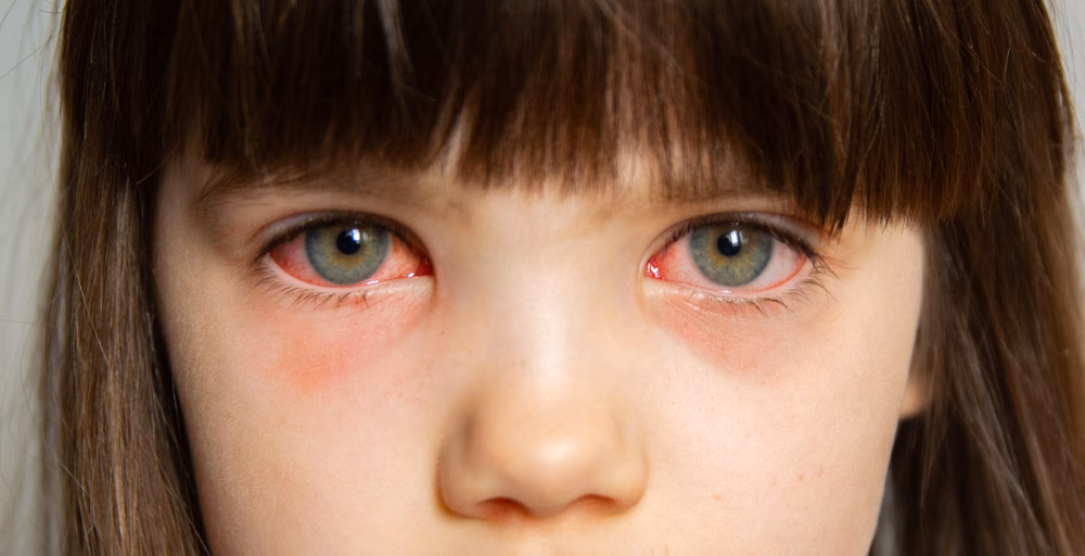 Ile zostać w domu przy zapaleniu spojówek?