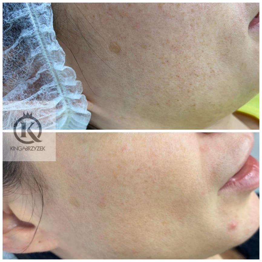 Co jest najskuteczniejsze na przebarwienia?