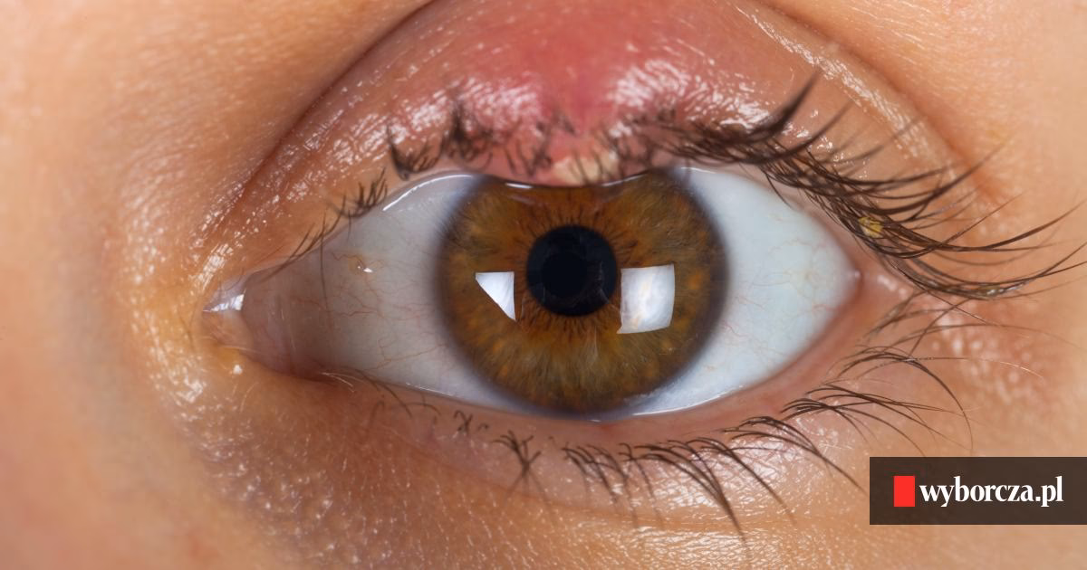 Czego nie robić, gdy ma się jęczmień?