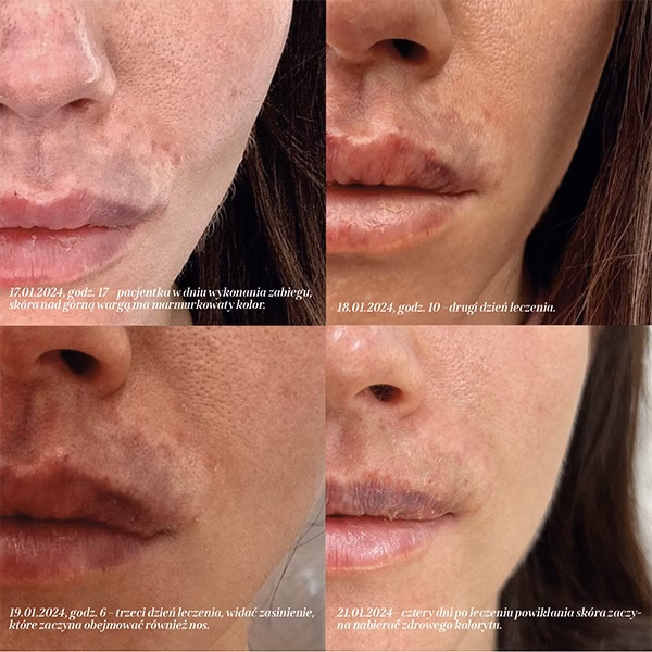 Ile kosztuje powiększanie ust Kielce?