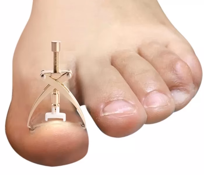 Czy można udać się do salonu kosmetycznego w przypadku wrastającego paznokcia?