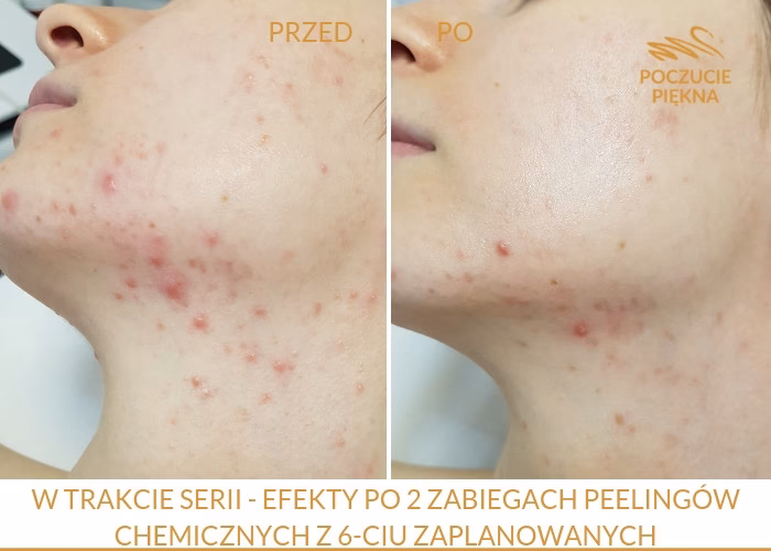 Jak kosmetyczka może leczyć trądzik?