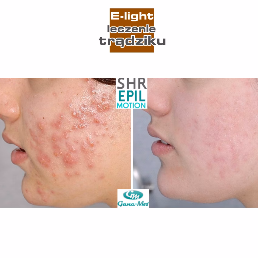 Czy kosmetyczka pomoże na trądzik?