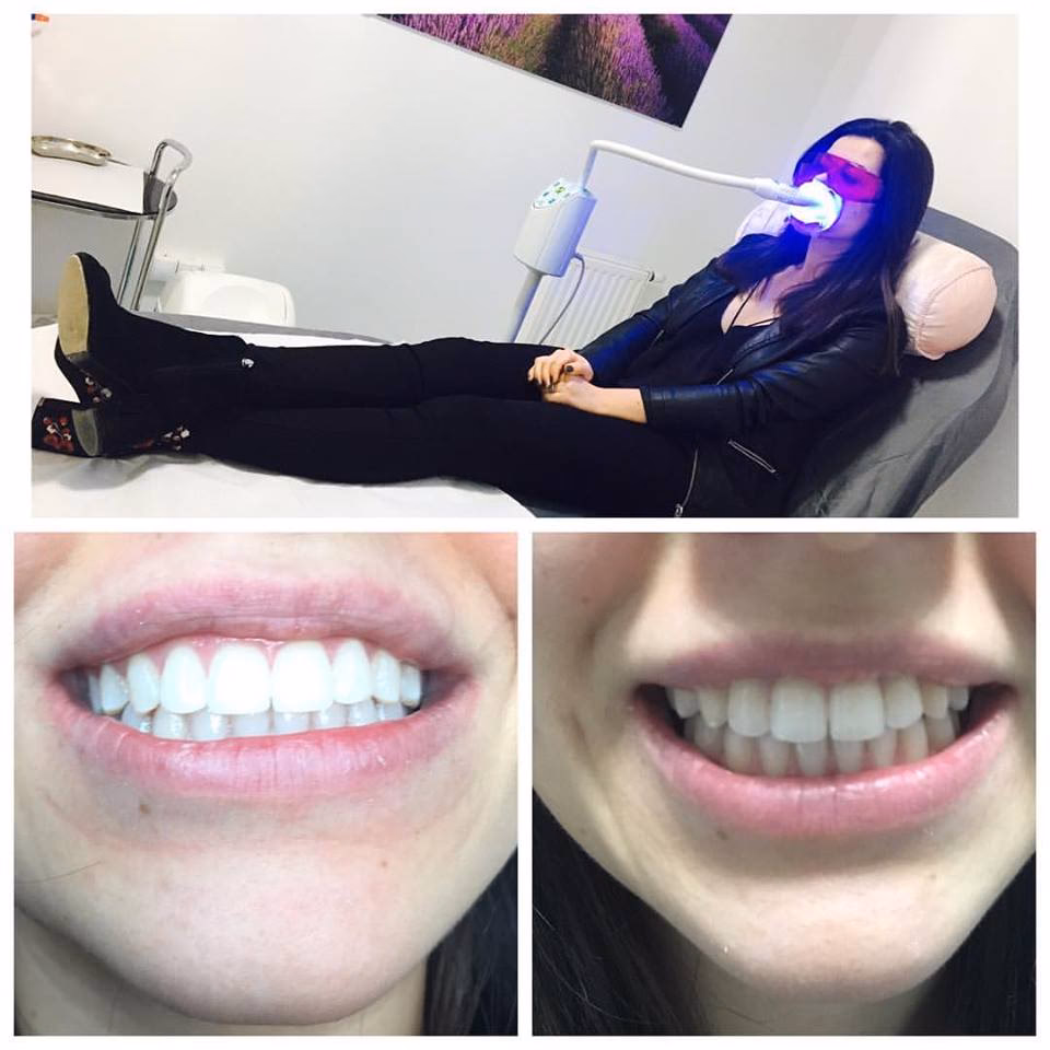 Czy salony kosmetyczne oferują wybielanie zębów?