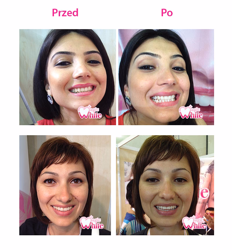 Kto może wykonywać wybielanie zębów?