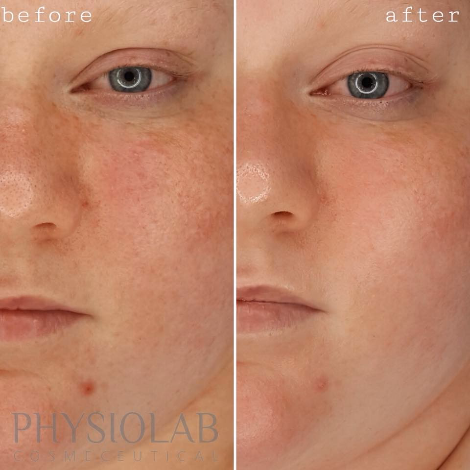 Jakie są skutki uboczne zabiegu BB Glow?