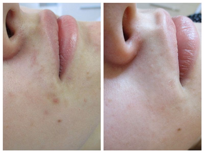 Czy kosmetyczka usuwa blizny?