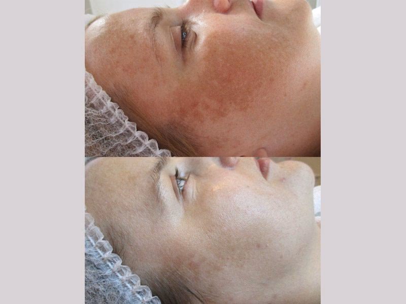 Jaki zabieg kosmetyczny na blizny po trądziku?