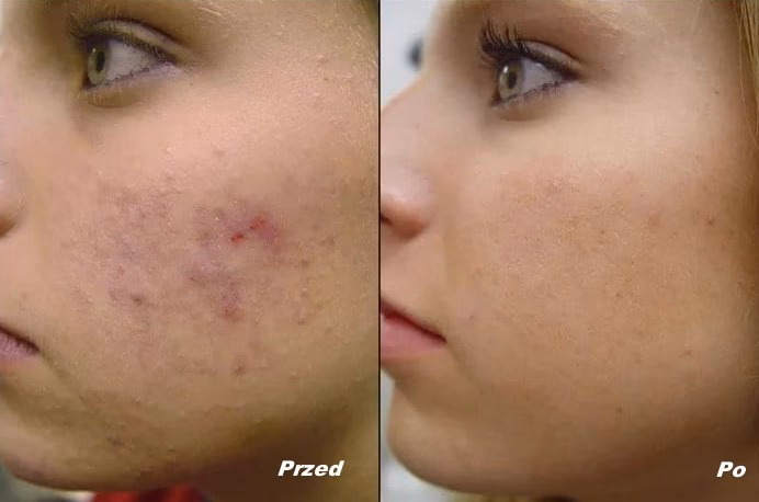 Ile kosztuje usunięcie blizny po trądziku?