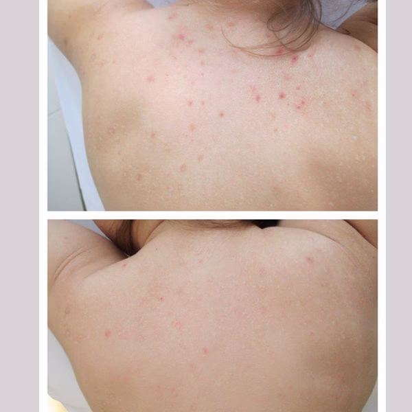 Który zabieg na twarz jest najlepszy na blizny potrądzikowe?