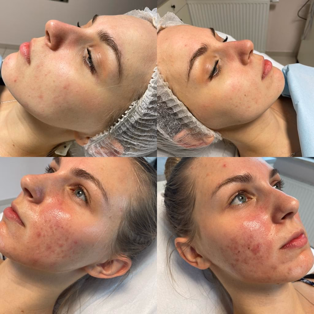 Ile kosztuje zabieg na trądzik?