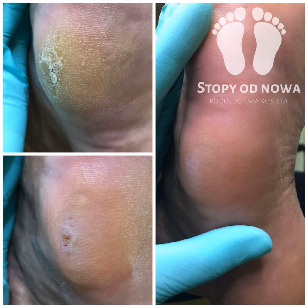 Czy można trwałe usunąć modzele?