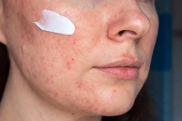 Czy kwas salicylowy leczy trądzik?