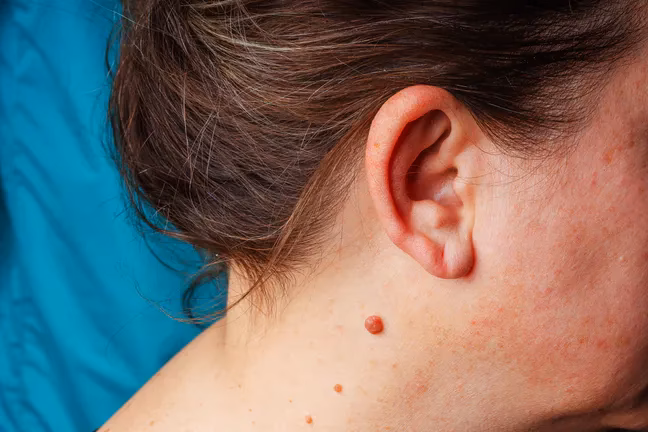 Czym usunąć brodawki z szyi?