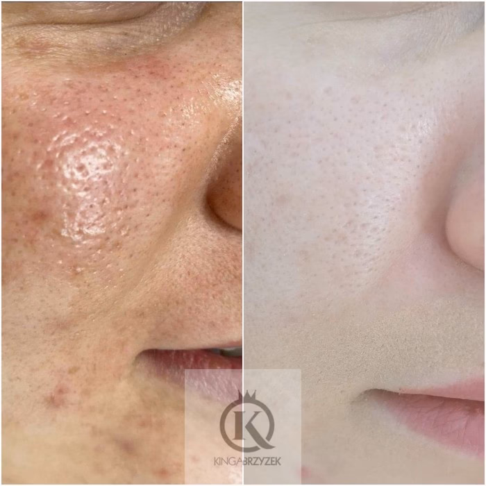 Jakie kwasy na twarz u kosmetyczki?