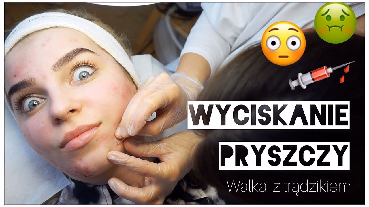 Dlaczego nie wolno wyciskać pryszczy?