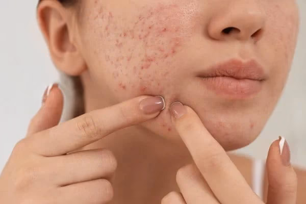 Czy kosmetyczka może wyciskać pryszcze?