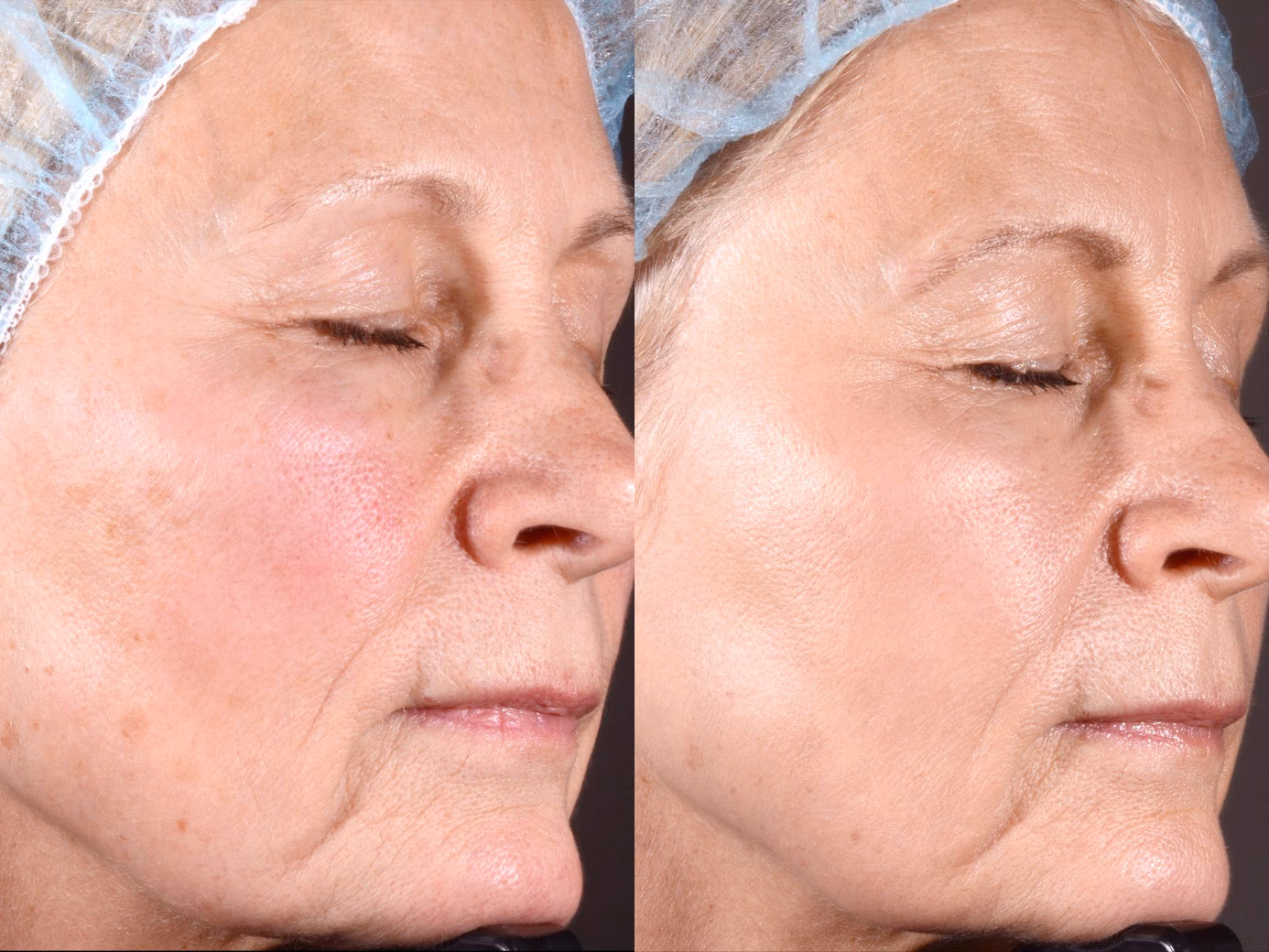 Czy laser Palomar jest dobry?