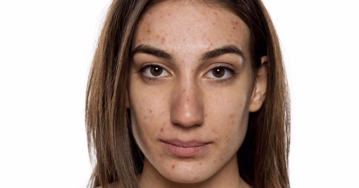 Jakie zabiegi na twarz przy izoteku?