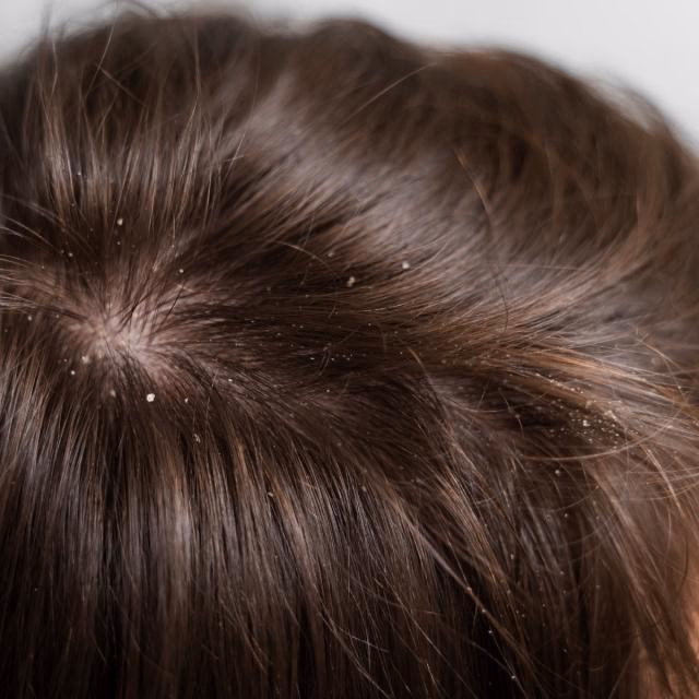 Jakich witamin brakuje przy łupieżu?